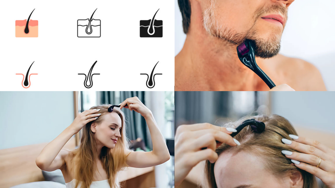 In-Depth Guide | Which Derma Roller Size is Best For Hair Regrowth?