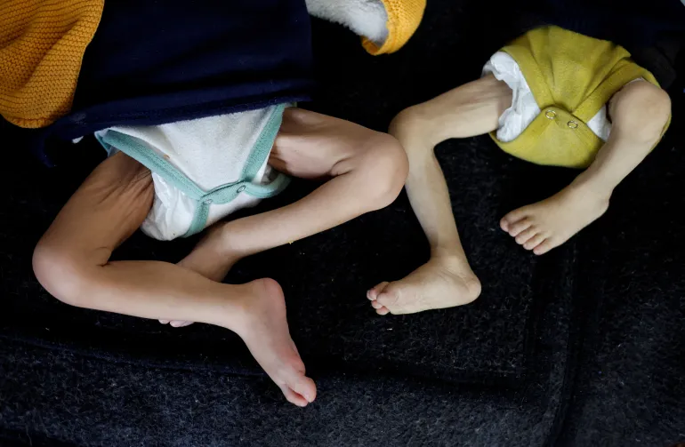 Malnutrition crisis in gaza deepens blood shortage, says health official