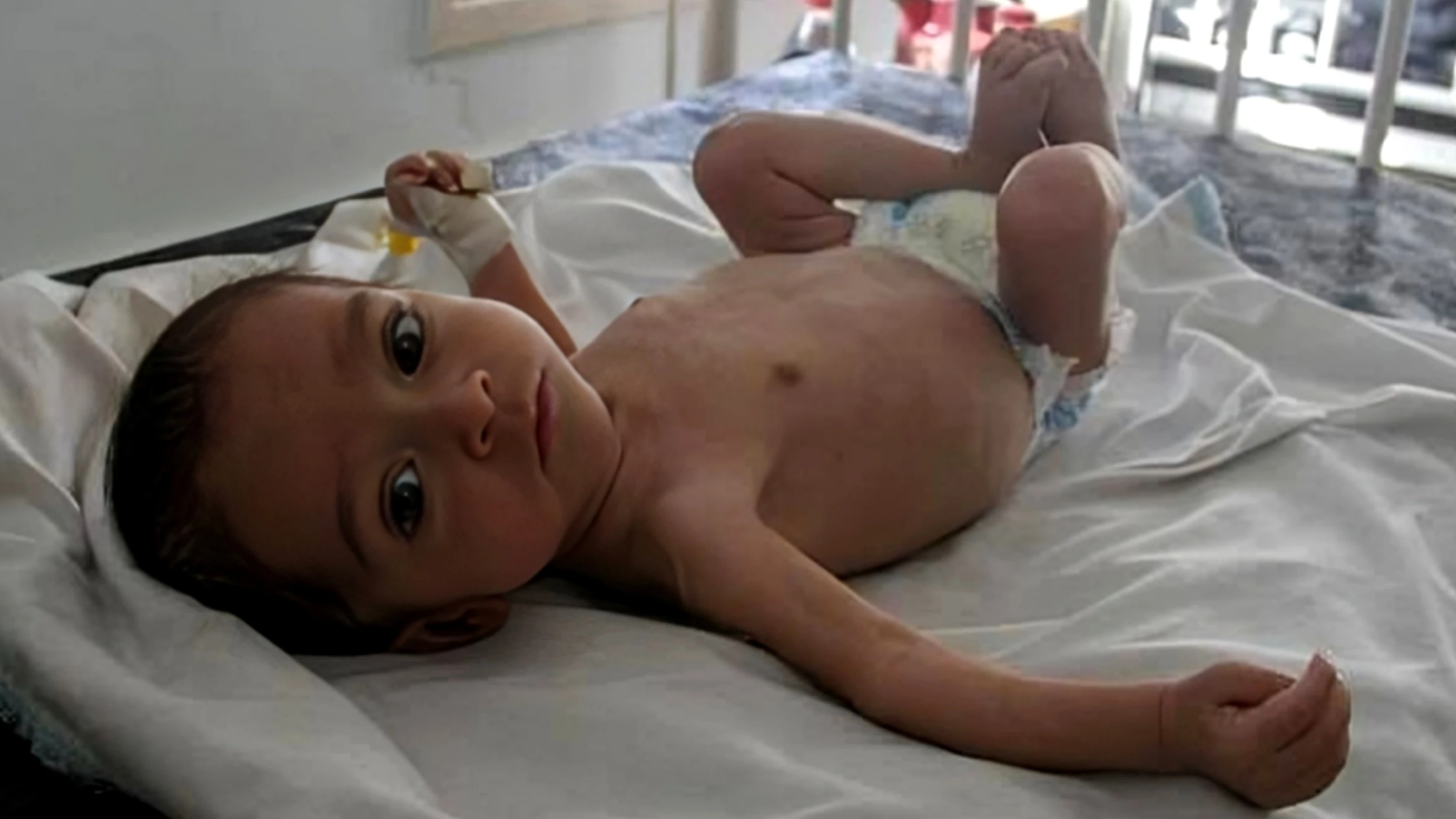 UN Raises Alarm Over Surge in Child Malnutrition in Gaza
