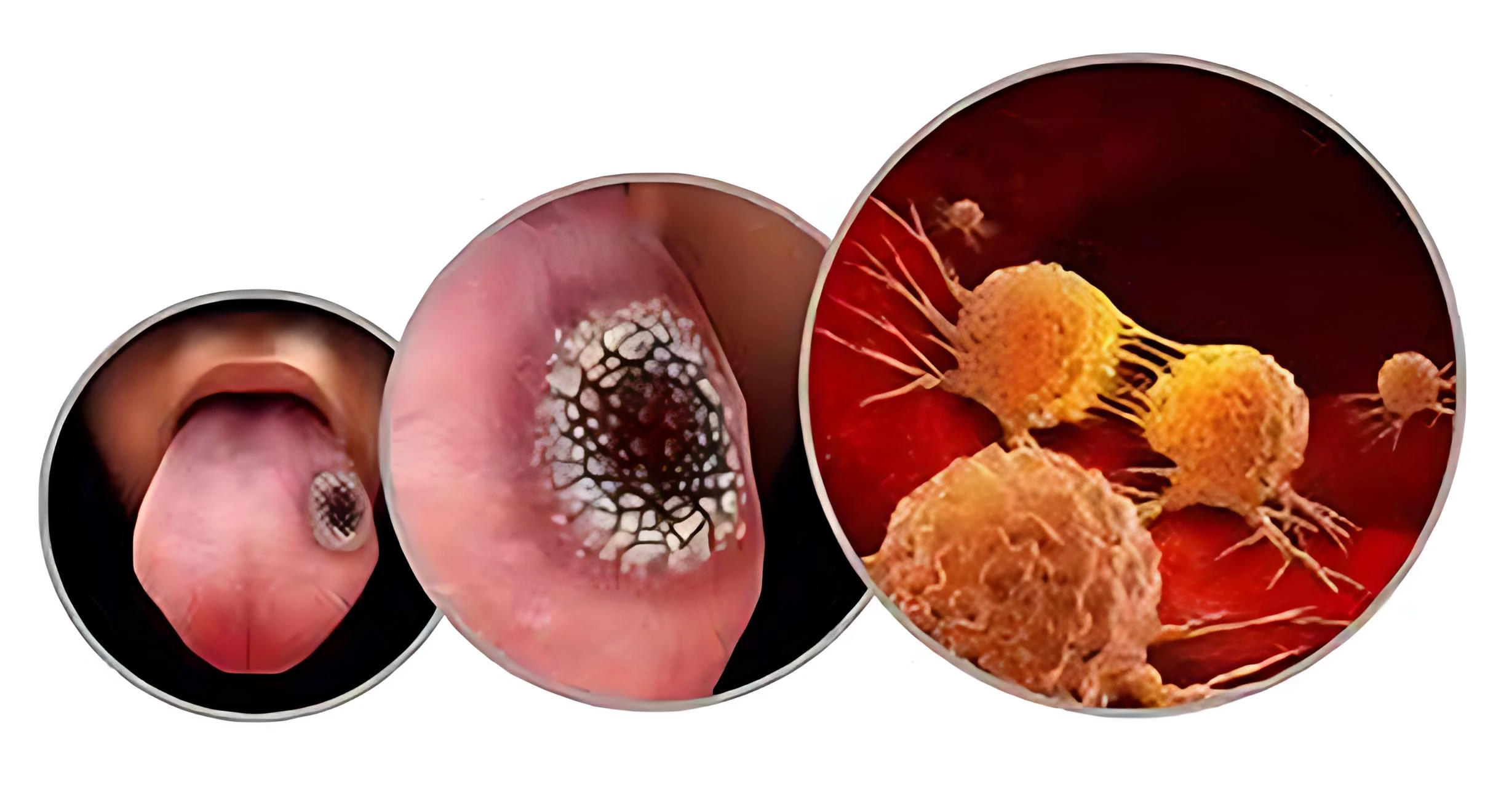 Oral cancer emerges as top silent killer among men in sindh