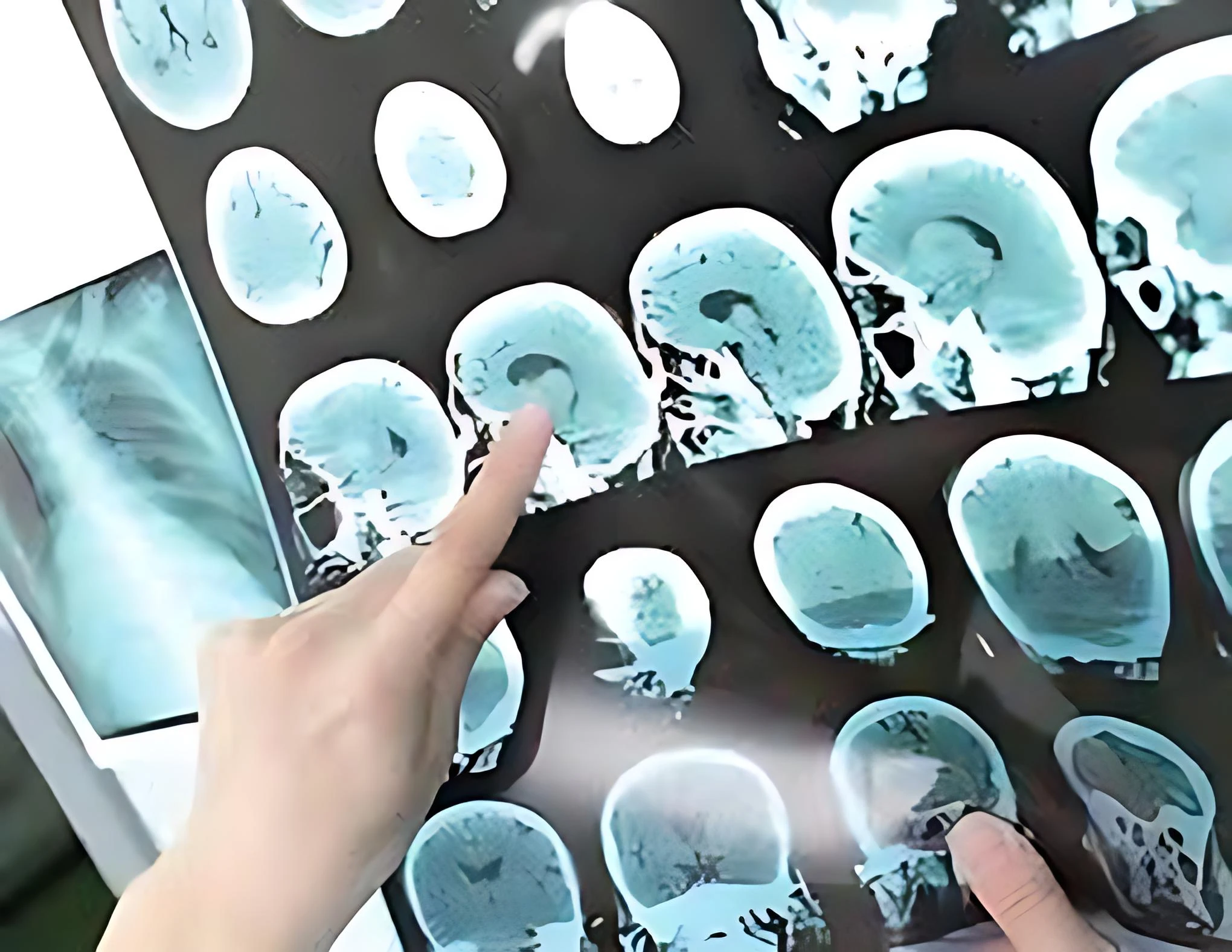 Food Insecurity Worsens Stroke Effects, Linked to Longer Life Post-Stroke