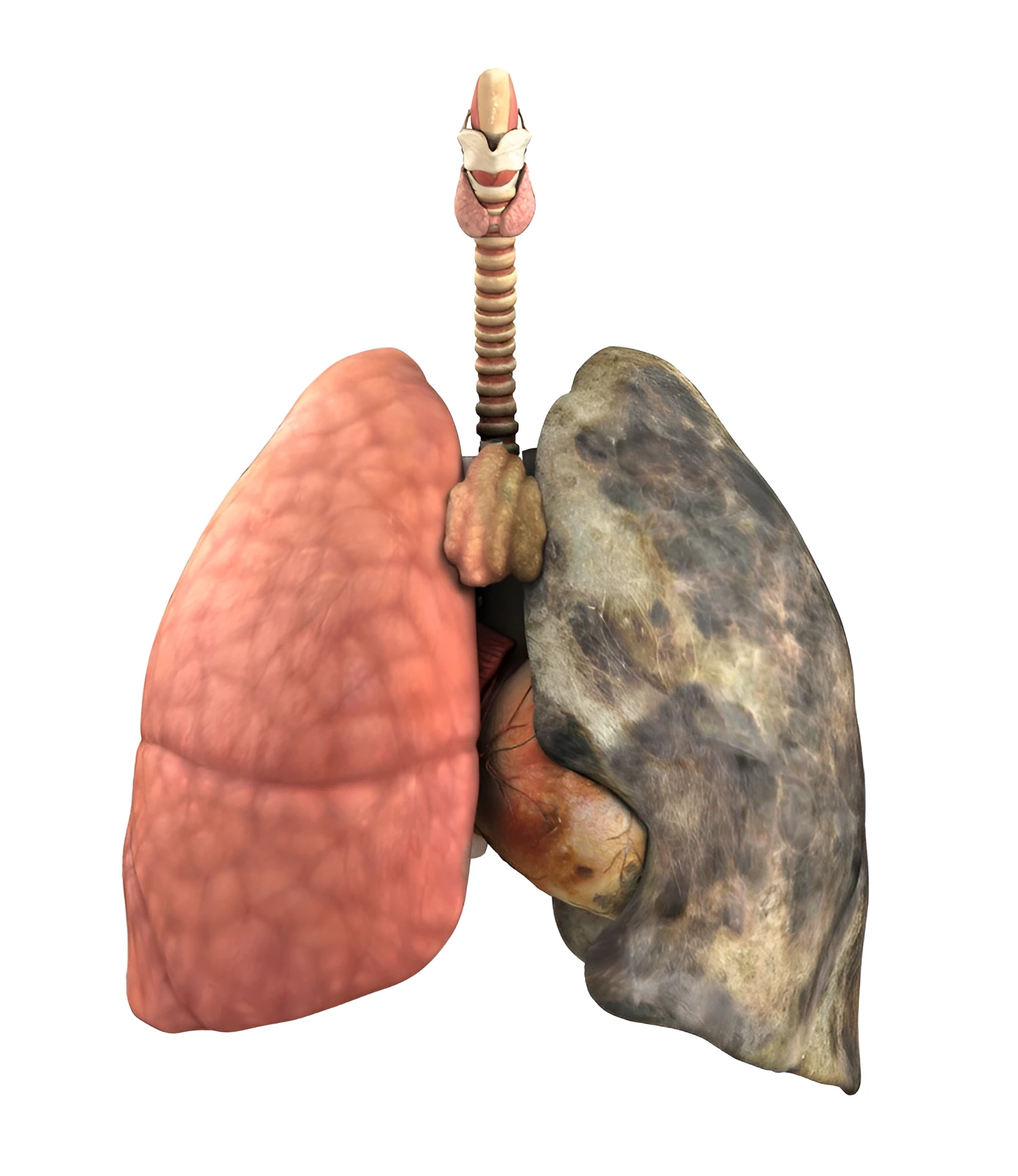 Copd patients have heavier lung pollution than smokers