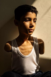 The Portrait of a Gaza Amputee Wins the 2025 World Press Photo Award