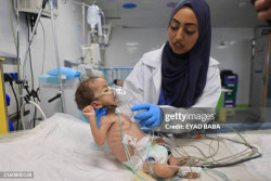 Over 65,000 Cases of Acute Malnutrition Among Children in Gaza