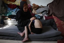 Gaza Hospitals Struggling as Malnutrition Cases Among Children Surge