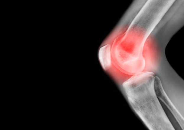 4 Evergreen Recommendations - What Is The Best Painkiller For Knee Pain?
