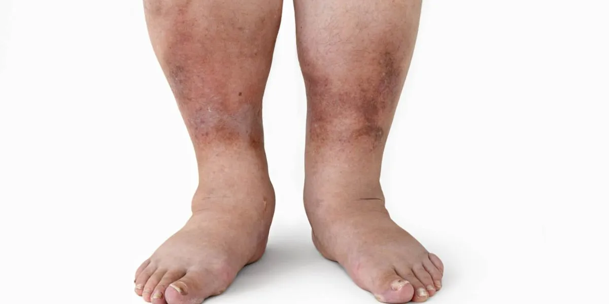 Short Flight Triggers Severe DVT In Woman, Expert Warns Travelers