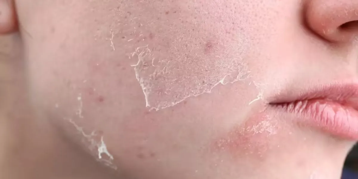 Winter Dry Skin Risk Increases With Excess Hot Drink Consumption