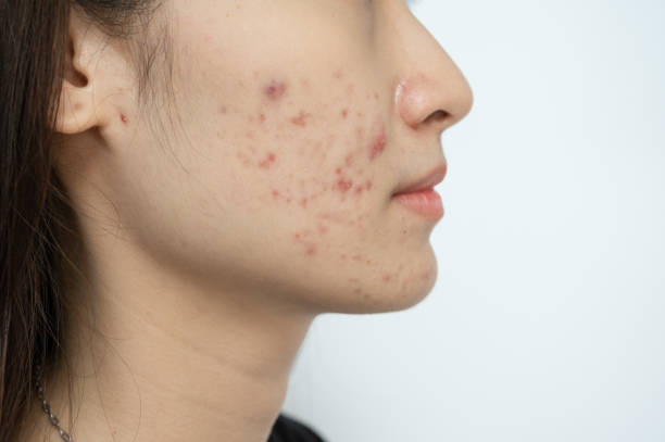 Step-By-Step Guide - How To Get Rid Of Redness On Face From Pimples?