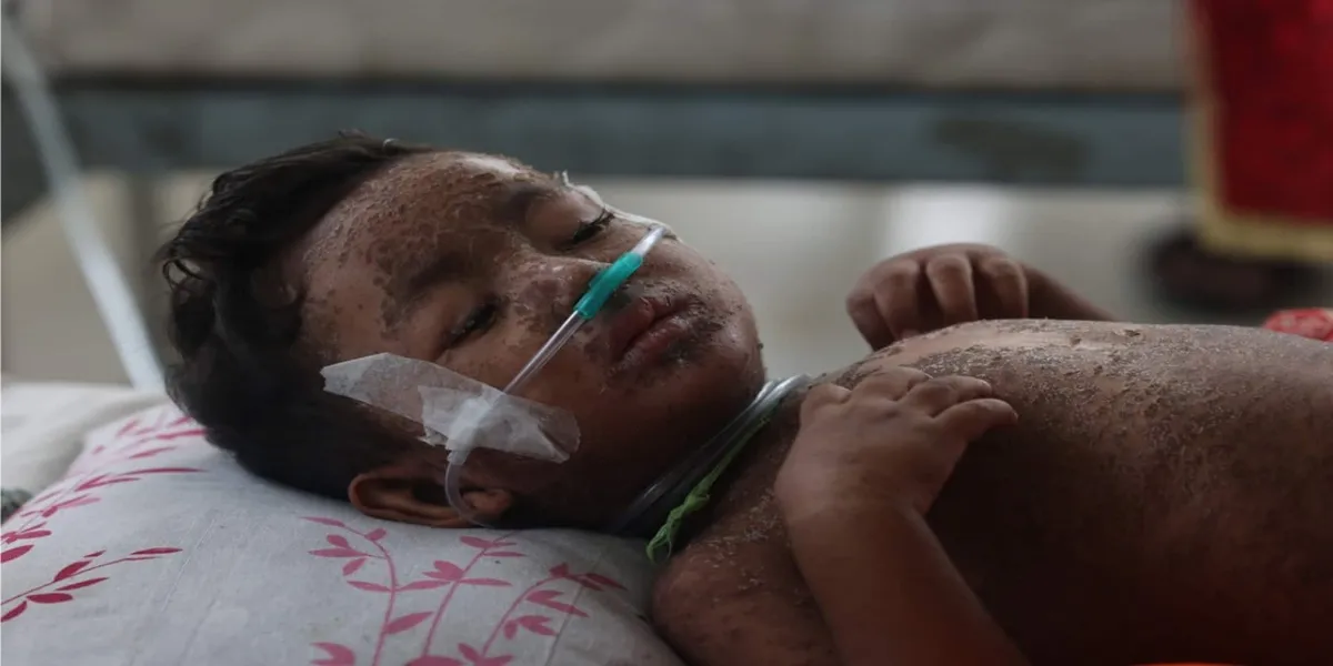 Bangladesh Measles Death Toll Rises to 409 After DGHS Revises Data