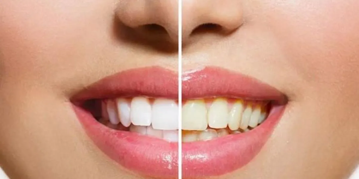 Simple Home Remedies Help Restore Natural White Teeth Effectively