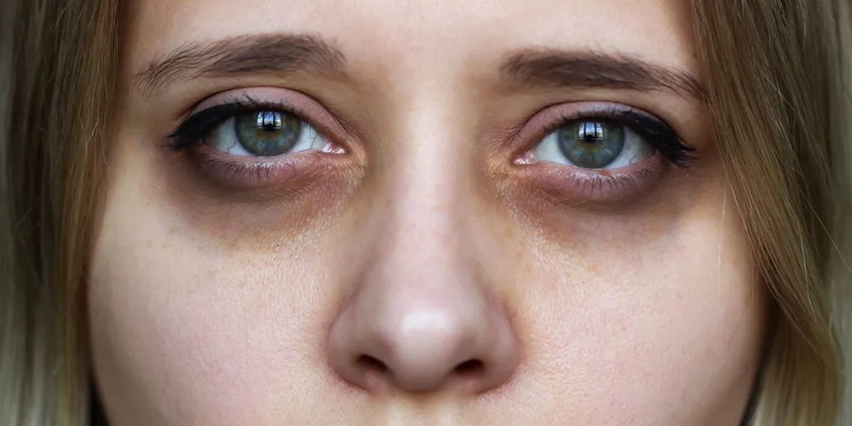 Dark Circles Under Eyes May Signal Serious Hidden Health Conditions