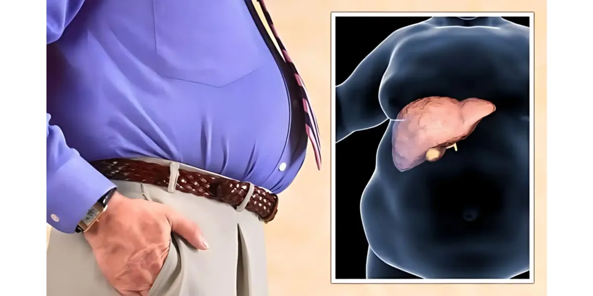 Fatty Liver Progression Tied to Higher Liver Cancer Risks | Human Online